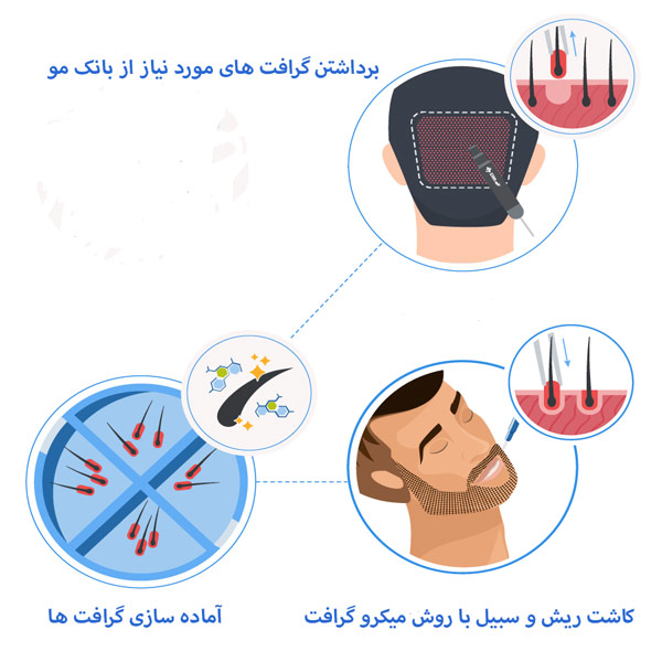 کاشت ریش و سبیل - مهران رضایی