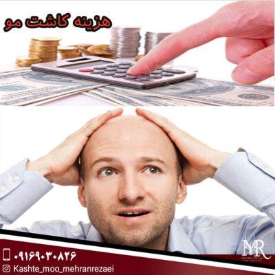 هزینه کاشت مو - مهران رضایی