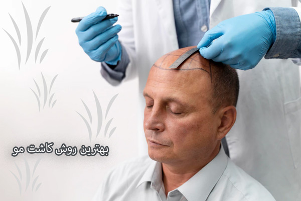 بهترین روش کاشت مو - مهران رضایی