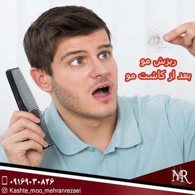 ریزش مو بعد از کاشت مو - مهران رضائی