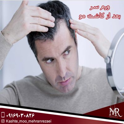 ورم سر بعد از کاشت مو - مهران رضایی