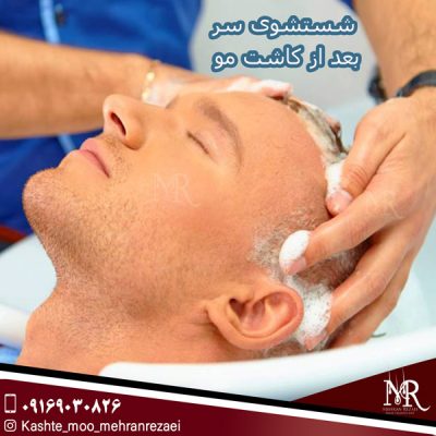 شستشوی سر بعد از کاشت مو - مهران رضایی