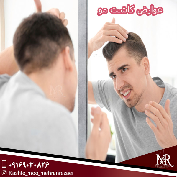 عوارض کاشت مو - مهران رضایی