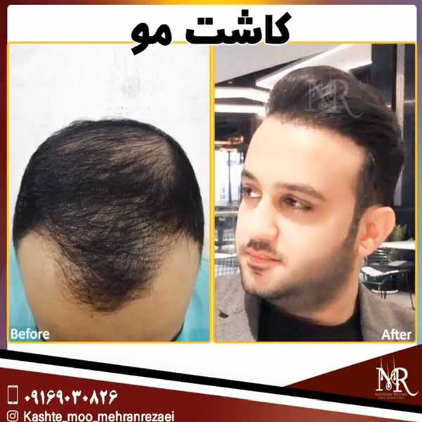 کاشت مو - مهران رضایی