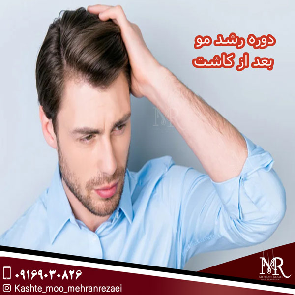 دوره رشد مو بعد از کاشت - مهران رضایی