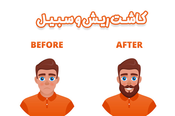 کاشت ریش و سبیل - مهران رضایی