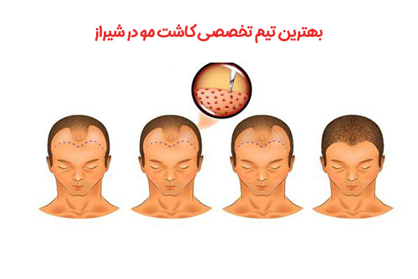 تیم تخصصی کاشت مو در شیراز - مهران رضایی