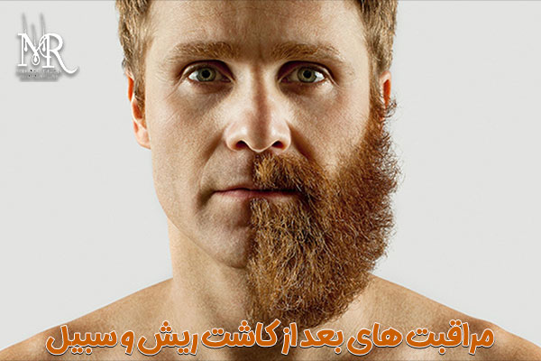 مراقبت های بعد از کاشت ریش و سبیل - مهران رضایی