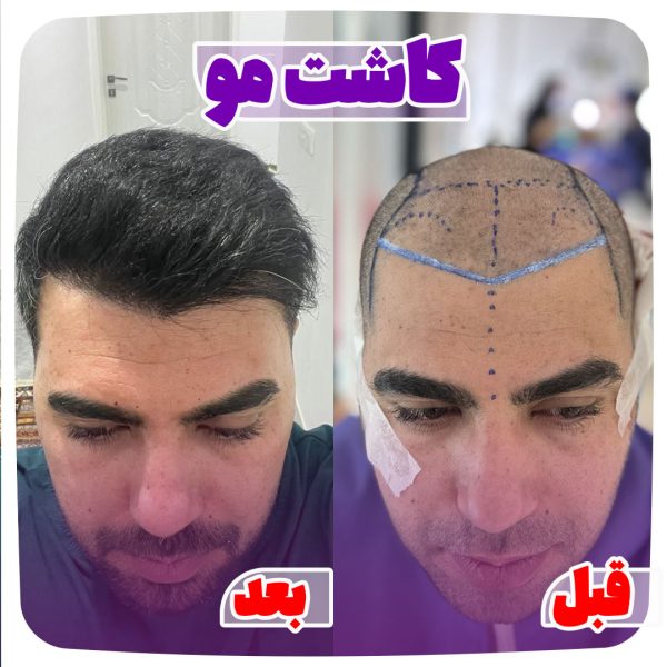 کاشت مو در شیراز