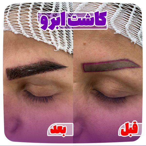 کاشت ابرو در شیراز