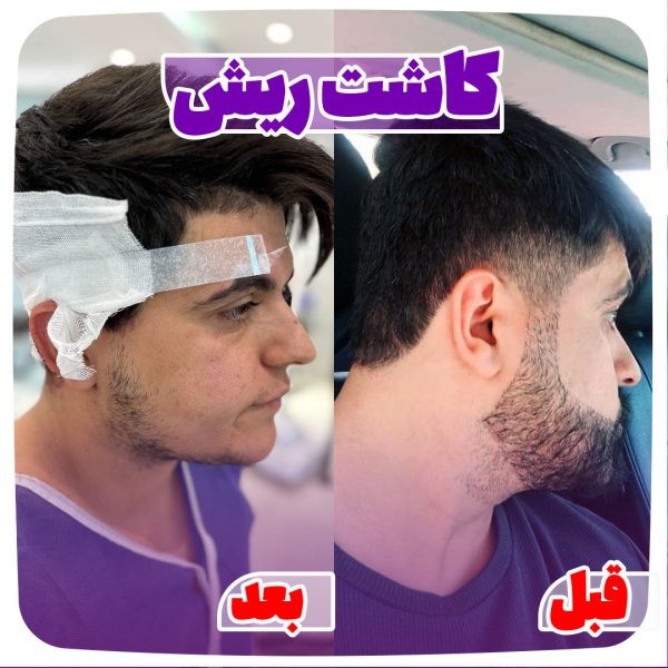 کاشت ریش در شیراز