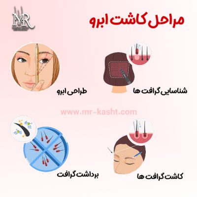 کاشت ابرو - مهران رضاییی
