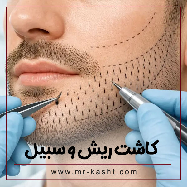 کاشت ریش و سبیل در شیراز با مهران رضایی