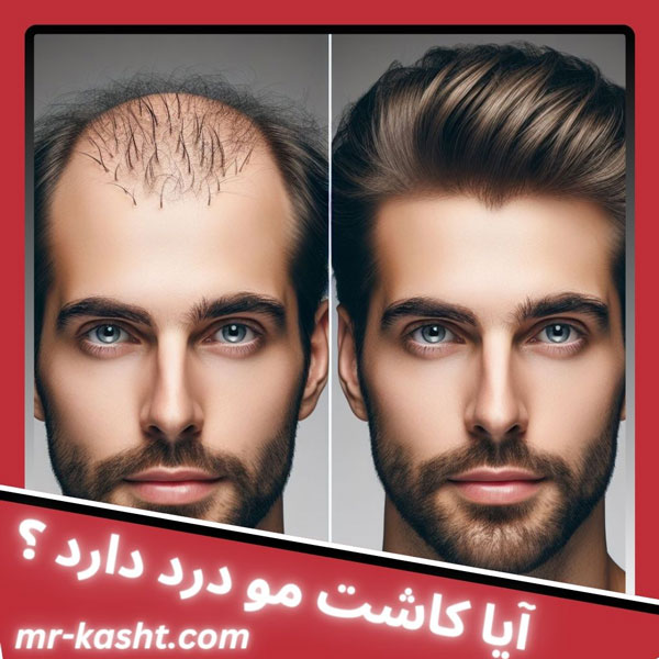 کاشت مو درد دارد ؟