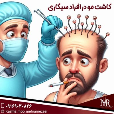 کاشت مو در افراد سیگاری - مهران رضایی