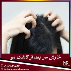 خارش سر بعد از کاشت مو - تیم تخصصی مهران رضایی