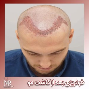 خونریزی بعد از کاشت مو - https://mr-kasht.com/