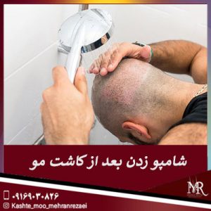 شامپو زدن بعد از کاشت مو | مهران رضایی