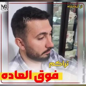 نمونه کار کاشت مو با ترکام فوق العاده بالا | تیم تخصصی مهران رضایی