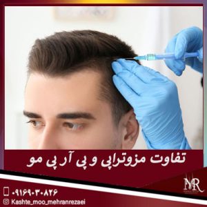 تفاوت مزوتراپی و پی آر پی مو | تیم تخصصی کاشت مو مهران رضایی شیراز