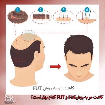 کاشت مو به روش FUT و FUE | کدام بهتر است؟