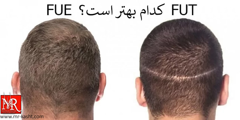 کاشت مو به روش FUT و FUE | کدام بهتر است؟