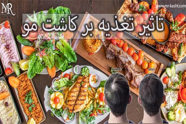 تاثیر تغذیه و سبک زندگی بر کاشت مو - مهران رضایی