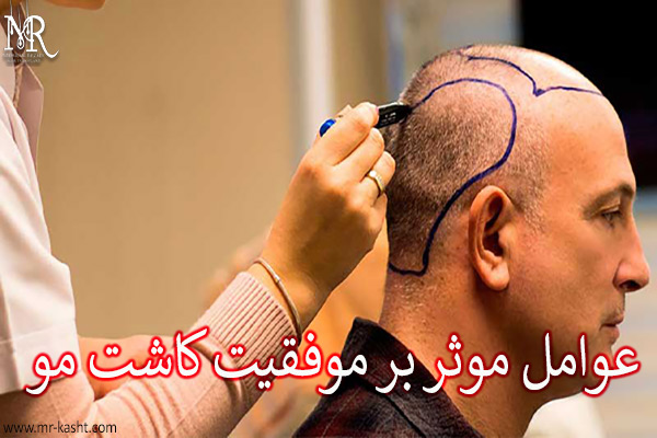 عوامل موثر بر موفقیت کاشت مو - مهران رضایی