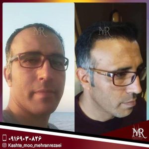 نمونه کار کاشت مو | مهران رضایی