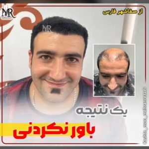 نمونه کار کاشت مو | مهران رضایی