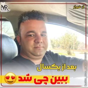 نمونه کار کاشت مو بعد از یک سال | تیم خصصی مهران رضایی
