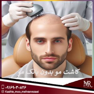 کاشت مو بدون بانک مو | تیم تخصصی مهران رضایی