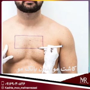 کاشت مو بدون بانک مو | تیم تخصصی مهران رضایی