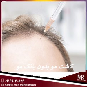 کاشت مو بدون بانک مو | تیم تخصصی مهران رضایی