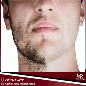 عوارض کاشت ریش و سبیل | تیم تخصصی مهران رضایی