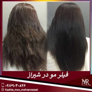 فیلر مو در شیراز | تیم تخصصی کاشت مو مهران رضایی