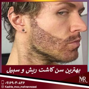 بهترین سن کاشت ریش و سبیل- تیم تخصصی مهران رضایی