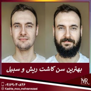 بهترین سن کاشت ریش و سبیل- تیم تخصصی مهران رضایی
