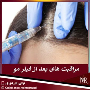 مراقبت های بعد از تزریق فیلر مو - تیم تخصصی مهران رضایی در شیراز