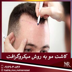 کاشت مو به روش میکروگرافت - مهران رضایی