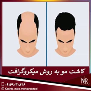 کاشت مو به روش میکروگرافت - مهران رضایی