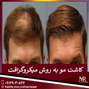 کاشت مو به روش میکروگرافت - مهران رضایی