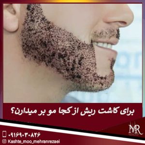 برای کاشت ریش از کجا مو بر میدارن؟ - تیم تخصصی مهران رضایی در شیراز