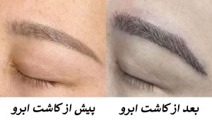 قبل و بعد از کاشت ابرو - تیم تخصصی مهران رضایی شیراز