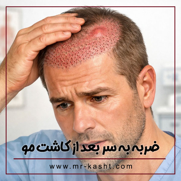ضربه به سر بعد از کاشت مو + تیم تخصصی کاشت مو مهران رضایی