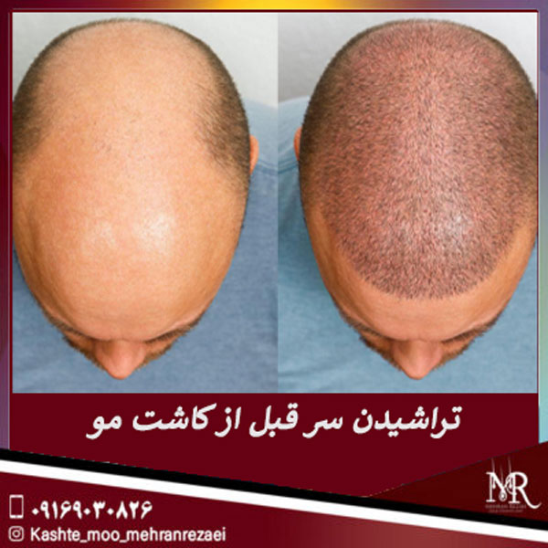 تراشیدن سر قبل از کاشت مو