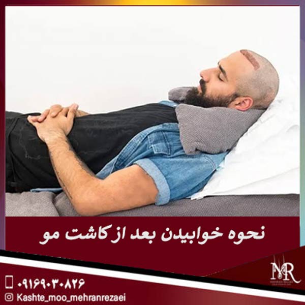 نحوه خوابیدن بعد از کاشت مو