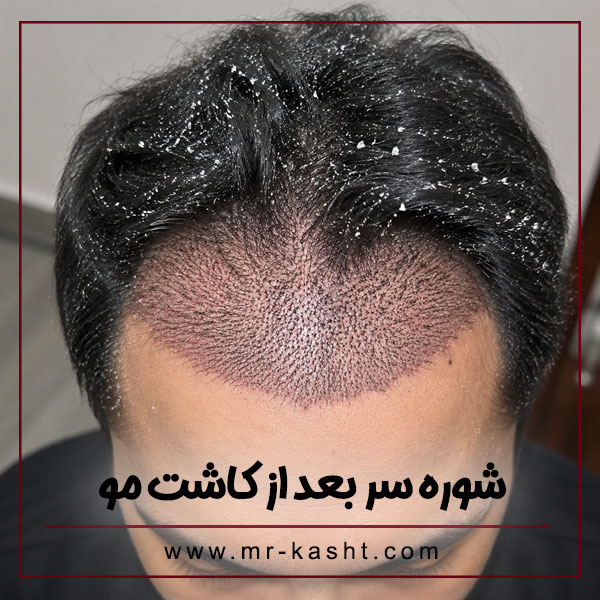 شوره سر بعد از کاشت مو + تیم تخصصی مهران رضایی در شیراز