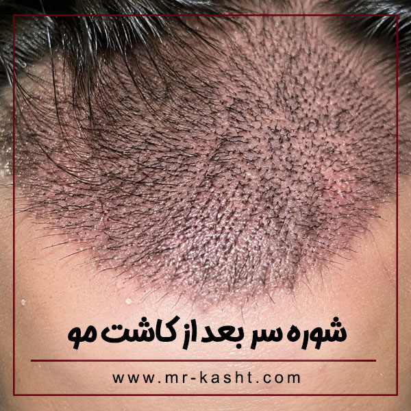 شوره سر بعد از کاشت مو + تیم تخصصی مهران رضایی در شیراز