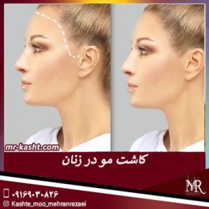 کاشت مو در زنان